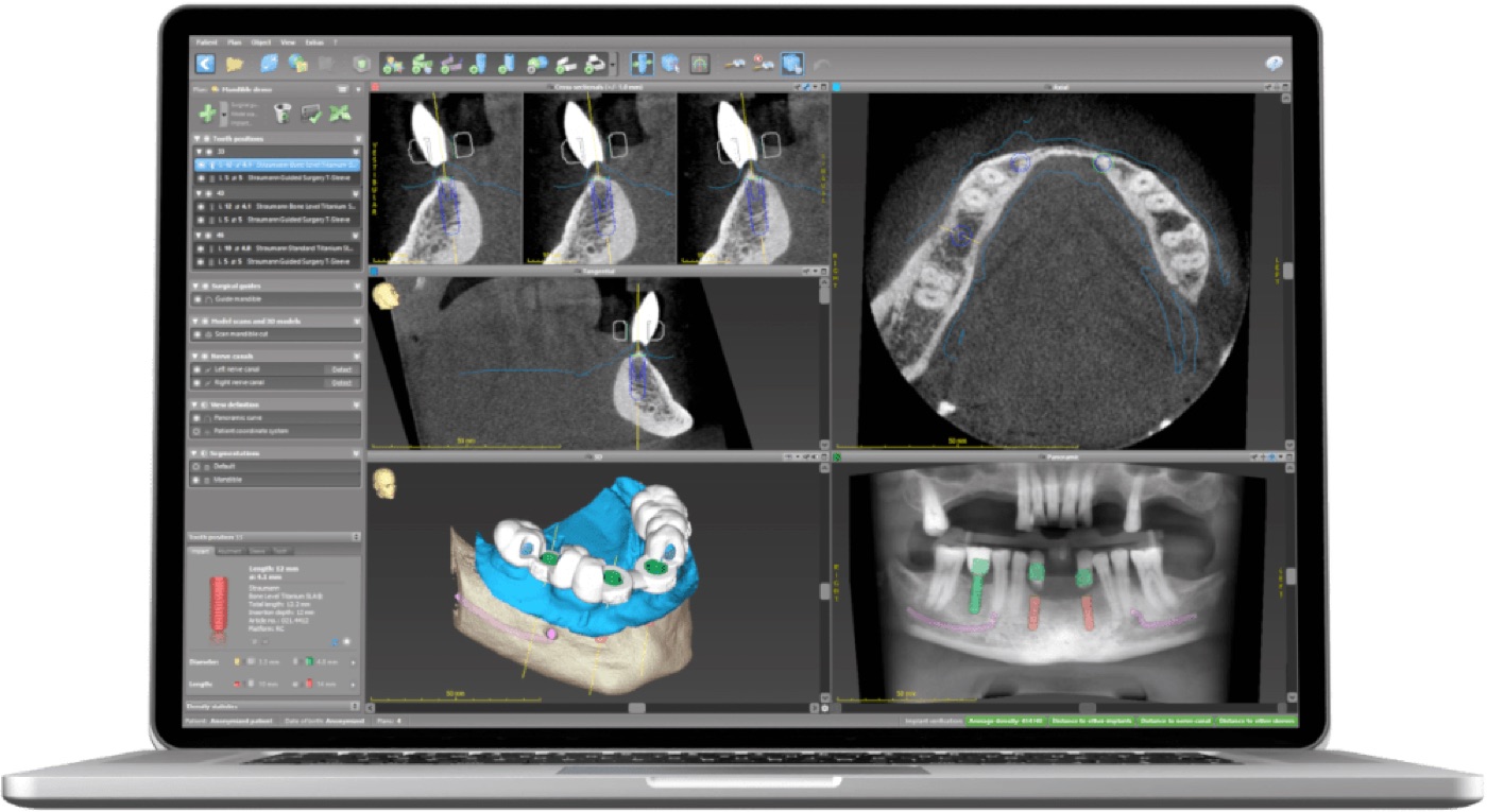 Planification 3D d'implants dentaires