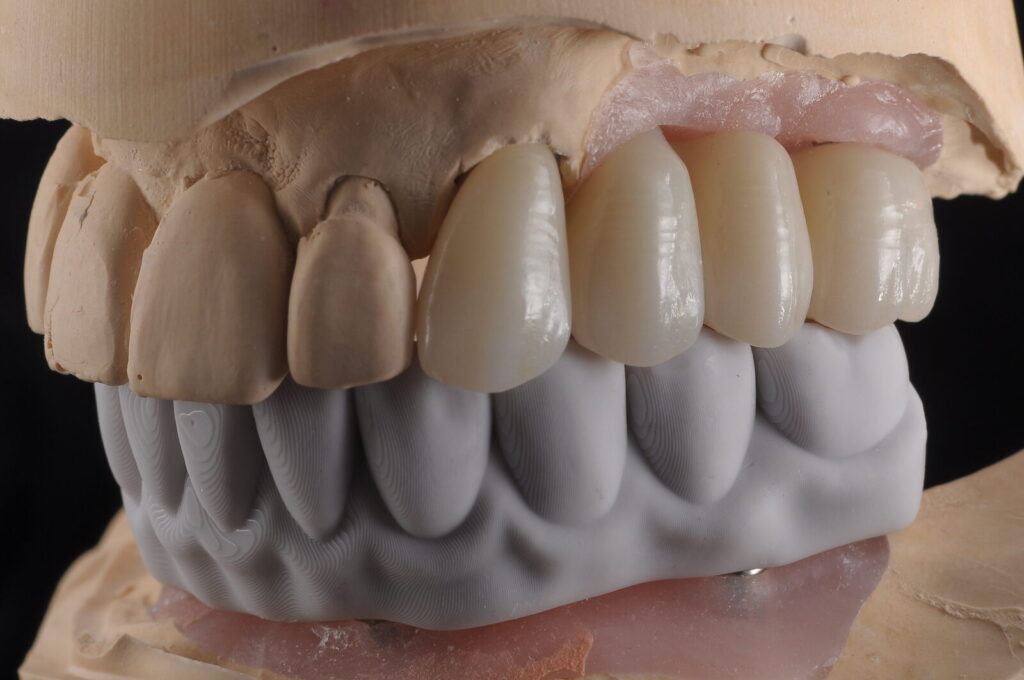 Prothèse fixe vissée sur implants