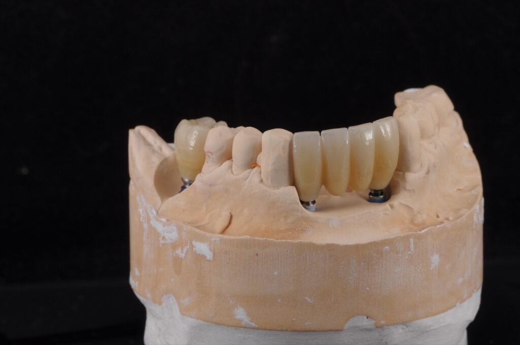 Prothèse sur implants