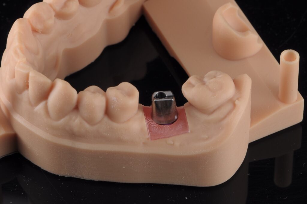 Modèle de travail imprimé avec analogue d'implant