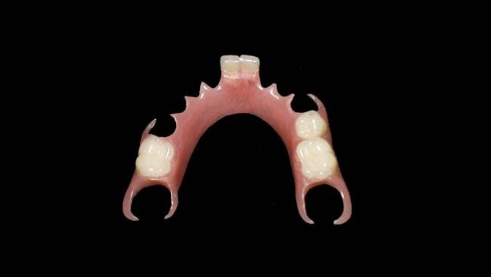 Flexite partial denture with no visible metal clasp