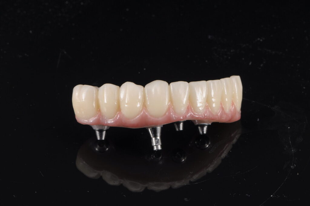 Pont en zircone vissé sur implants avec fausse gencive